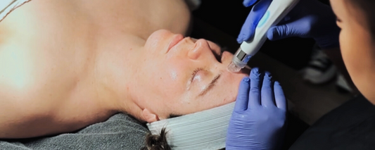 Everything You Need to Know About Hydradermabrasion