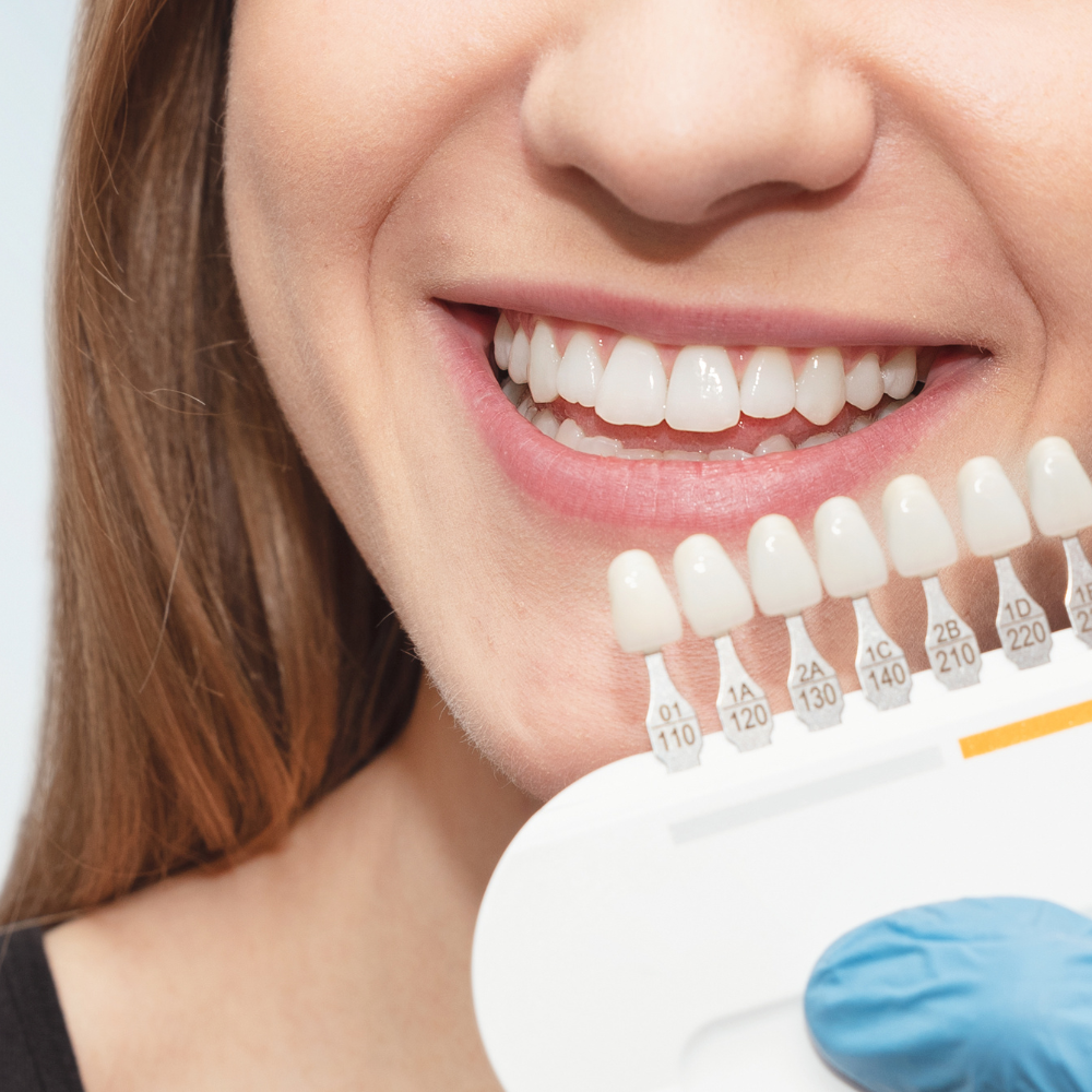 Teeth Whitening - Vita Beauty Bar