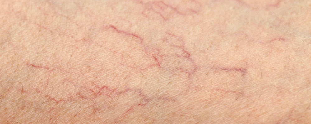 Vascular Lesions - Vita Beauty Bar