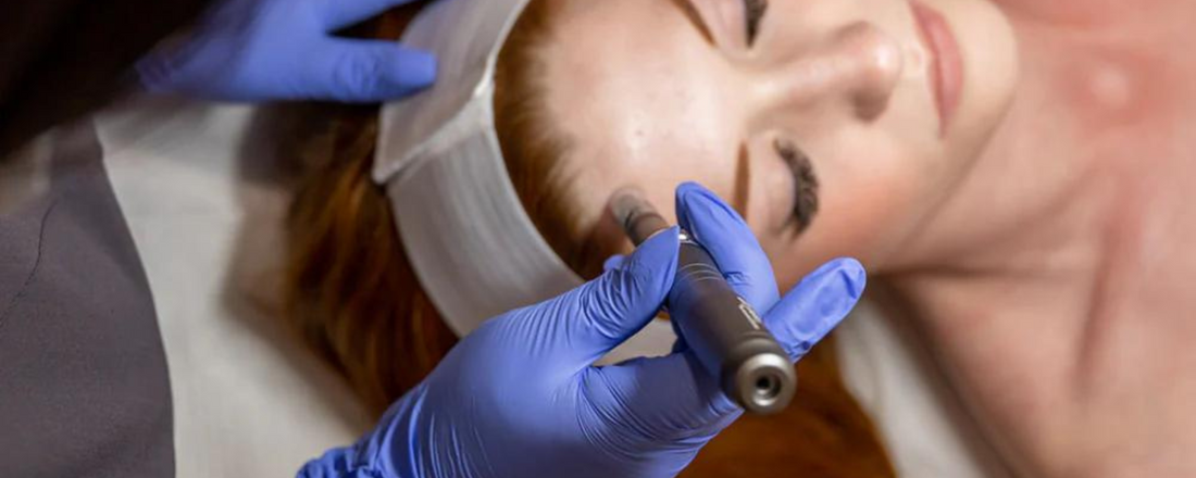 Everything You Need To Know About Microneedling