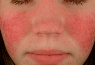 Diffuse Redness (Rosacea & Vascularity) – Vita Beauty Bar