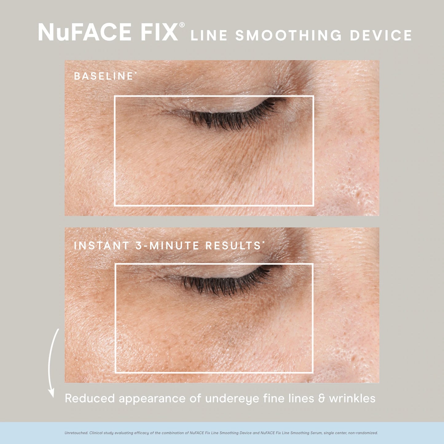 NuFACE FIX Device